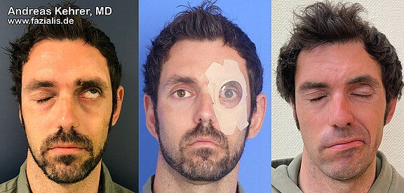 Gold_Platinimplantate_Auge_8.jpg 