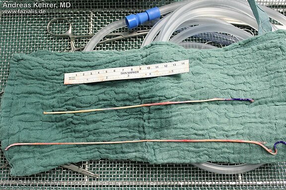 Nervenumlagerungen_und_Nerventransplantation_3.JPG 