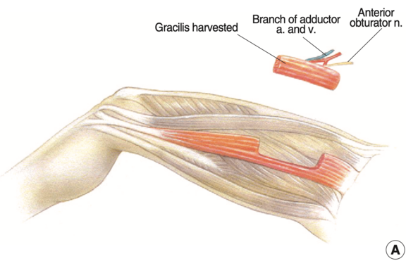 Freie_Muskeltransplantation_2.png 