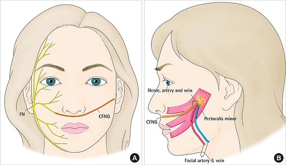 Nervenumlagerungen_und_Nerventransplantation_1.jpg 