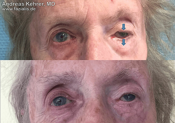 Gold_Platinimplantate_Auge_1.jpg 