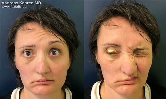 Gold_Platinimplantate_Auge_6.jpg 