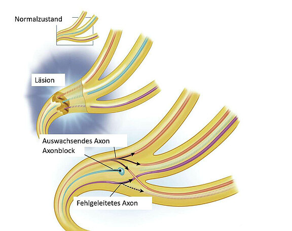 Synkinesien